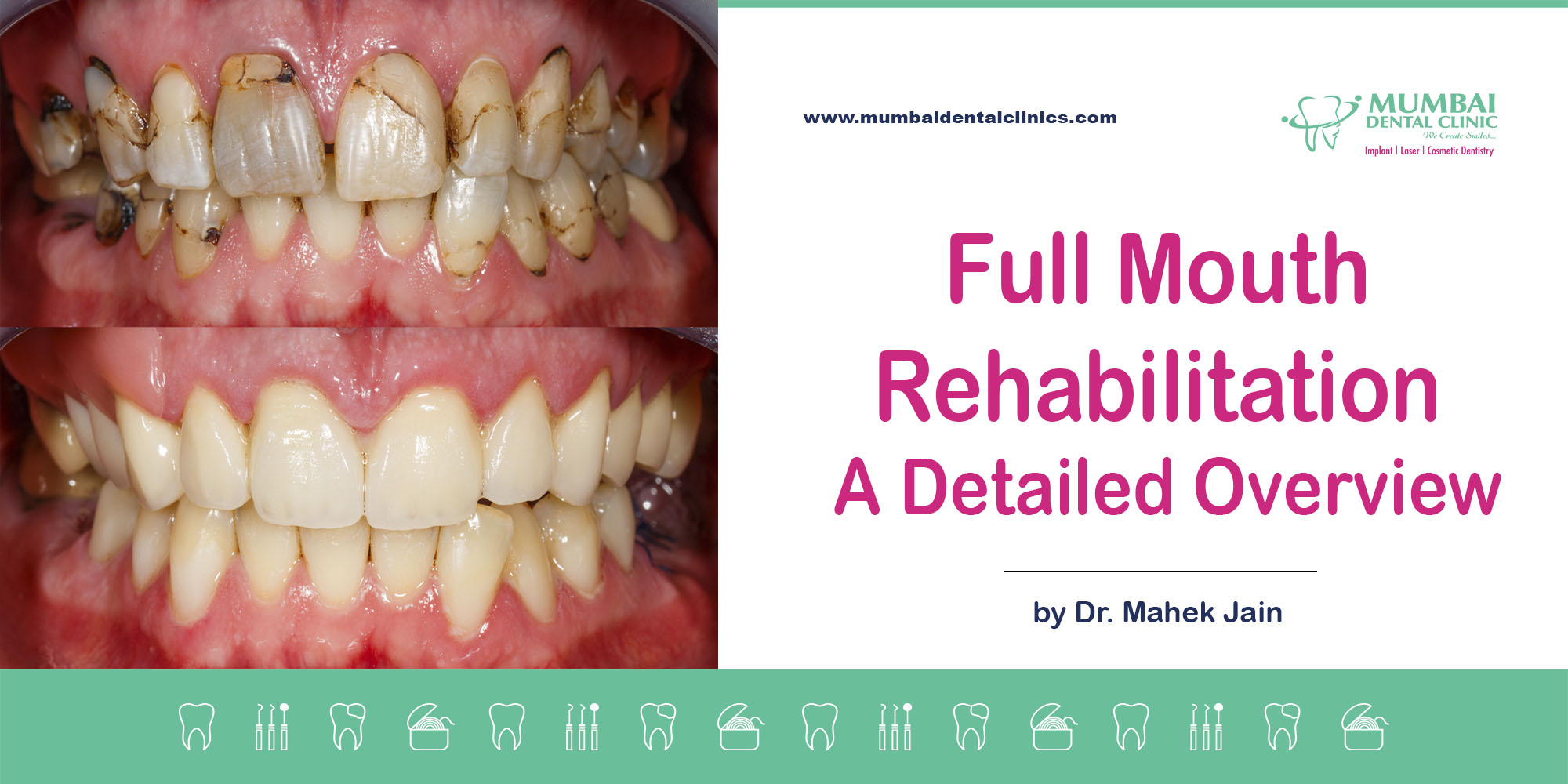 Importance of smile designing in your life, best dentist in udaipur,smile designing treatment in udaipur,Braces specialist in Udaipur,Braces doctor in Udaipur,full mouth rehabilitation treatment in udaipur