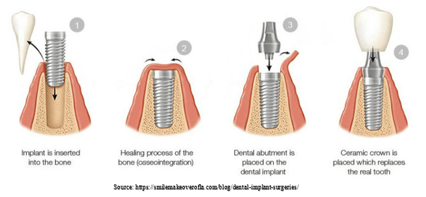 Dental implants in Udaipur