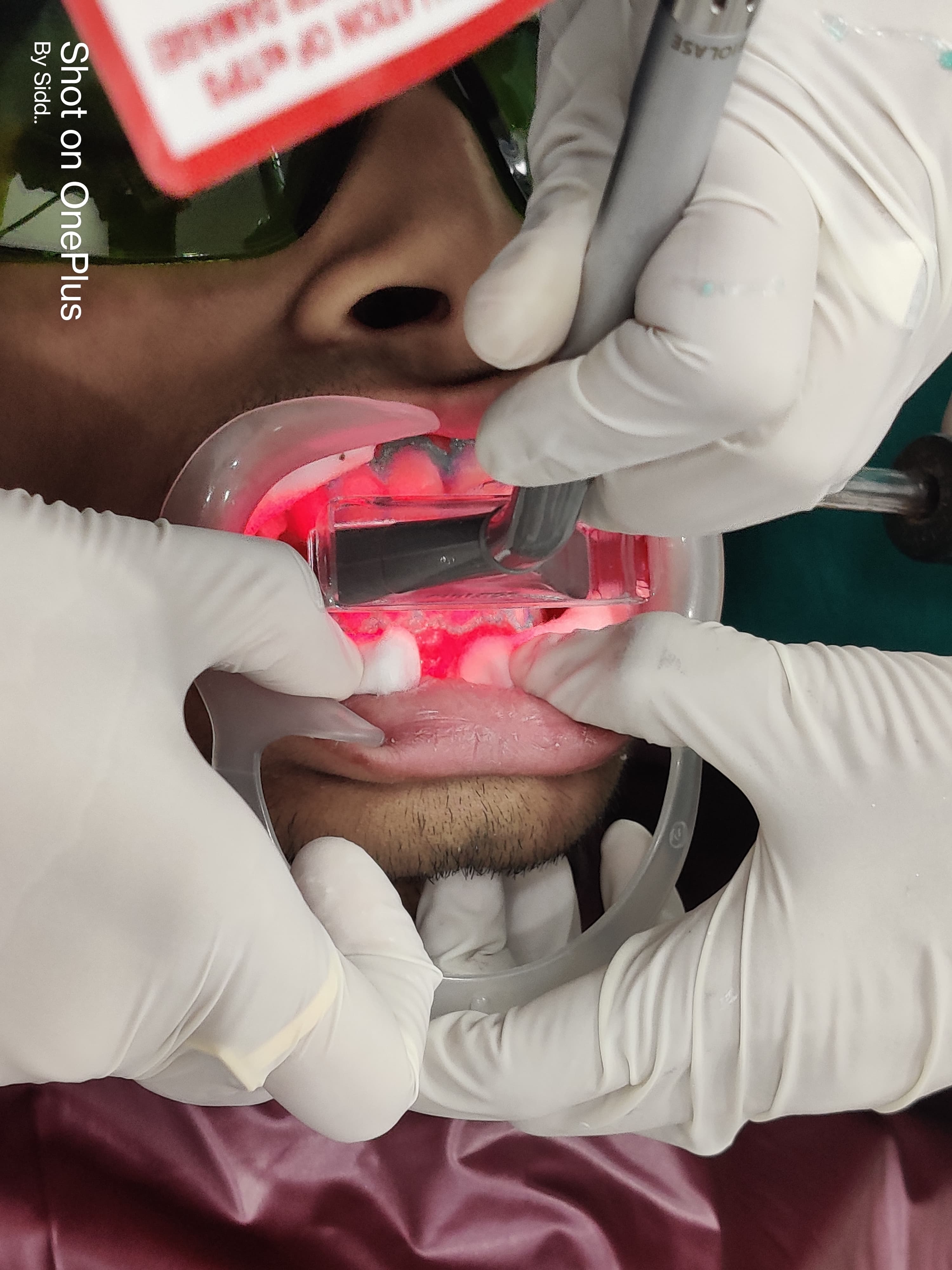 laser dental treatment in udaipur